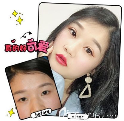 重慶愛(ài)思特雙眼皮怎么樣