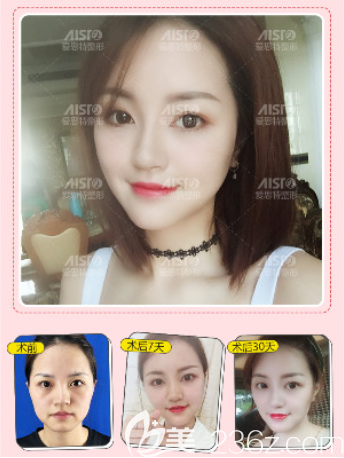 重慶愛(ài)思特瘦臉除皺瘦臉