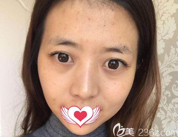 在<!--<i data=20240703-sp></i>-->整形做自體脂肪面部填充手術(shù)前 在<!--<i data=20240703-sp></i>-->整形做自體脂肪面部填充手術(shù)前