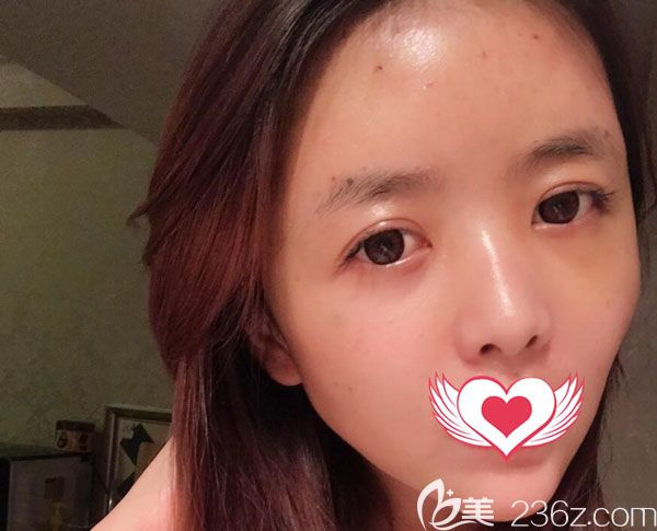 全臉填充第7天腫脹基本已經(jīng)消退 全臉填充第7天腫脹基本已經(jīng)消退