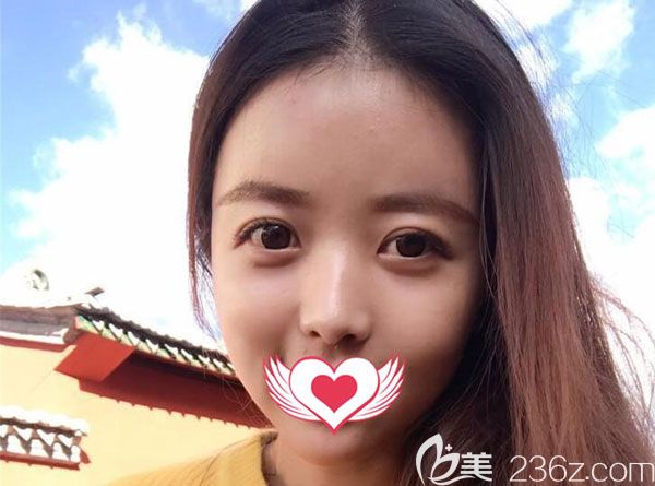 脂肪填充15天輪廓清晰 脂肪填充15天輪廓清晰