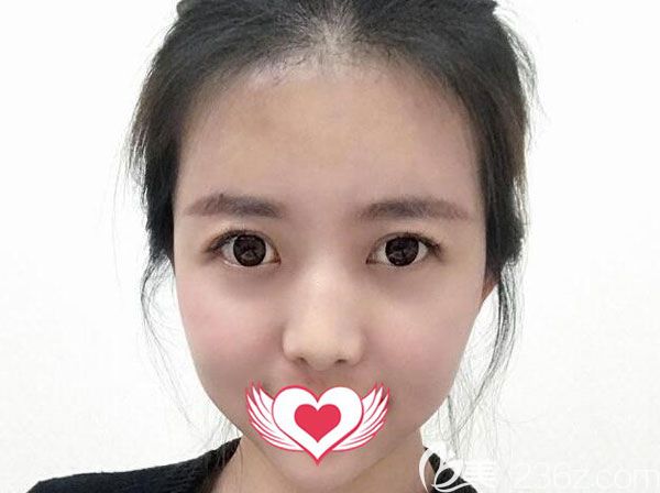 脂肪填充全臉30天面部脂肪已經(jīng)穩(wěn)定 脂肪填充全臉30天面部脂肪已經(jīng)穩(wěn)定