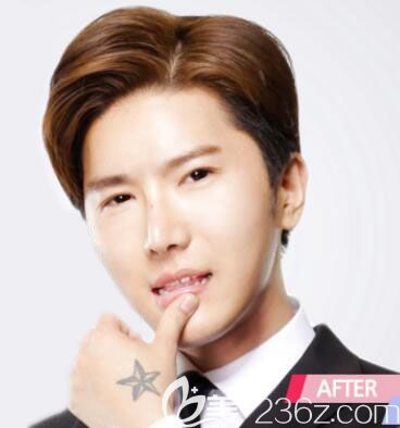 韓國(guó)然之美整形外科醫(yī)院眼綜合+鼻綜合隆鼻+脂肪填充額頭+假體墊下巴打造歐巴實(shí)記