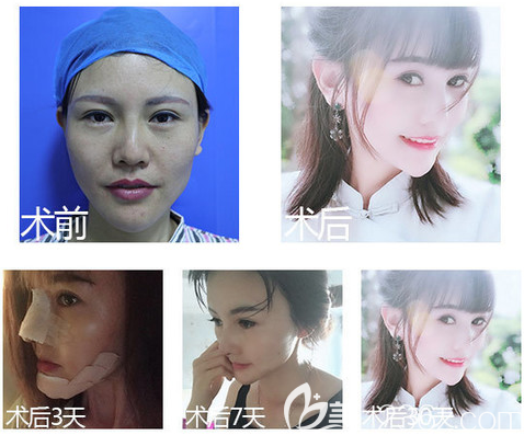 佛山華美雷朝勇院長隆鼻案例 佛山華美雷朝勇院長隆鼻案例