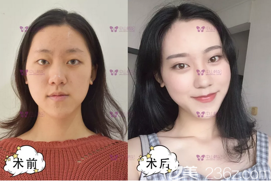 中山韓妃李光琴醫(yī)生雙眼皮案例