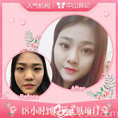 中山韓妃李光琴雙眼皮和隆鼻修復(fù)案例