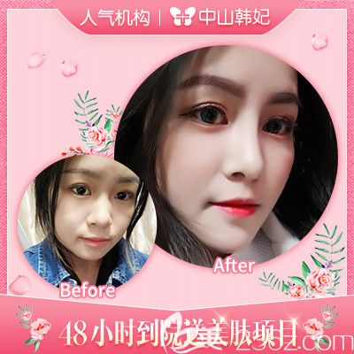 中山韓妃李光琴醫(yī)生肋軟骨隆鼻案例