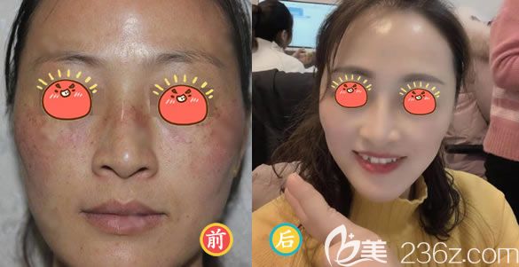 湖州尚麗曾令濟(jì)激光祛斑案例 湖州尚麗曾令濟(jì)激光祛斑案例