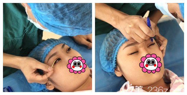 張悅迪醫(yī)生設(shè)計(jì)雙眼皮方案