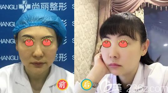 湖州尚麗姜艷面部線雕提升案例 湖州尚麗姜艷面部線雕提升案例
