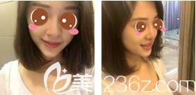 <!--<i data=20240703-sp></i>-->光博士醫(yī)療美容門診部吳莉平玻尿酸隆鼻真人案例術(shù)前照 <!--<i data=20240703-sp></i>-->光博士醫(yī)療美容門診部吳莉平玻尿酸隆鼻真人案例術(shù)前照