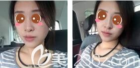 <!--<i data=20240703-sp></i>-->光博士醫(yī)療美容門診部吳莉平玻尿酸隆鼻真人案例術(shù)后第二天 <!--<i data=20240703-sp></i>-->光博士醫(yī)療美容門診部吳莉平玻尿酸隆鼻真人案例術(shù)后第二天