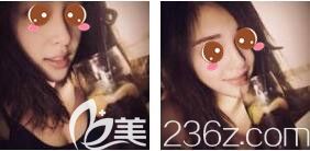 <!--<i data=20240703-sp></i>-->光博士醫(yī)療美容門診部吳莉平玻尿酸隆鼻真人案例術(shù)后十五天 <!--<i data=20240703-sp></i>-->光博士醫(yī)療美容門診部吳莉平玻尿酸隆鼻真人案例術(shù)后十五天