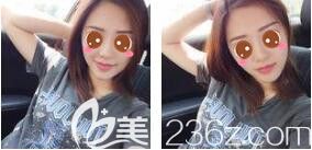 早知道玻尿酸隆鼻價(jià)格不貴效果這么自然我當(dāng)時(shí)就應(yīng)該帶好閨蜜一起來(lái)做了