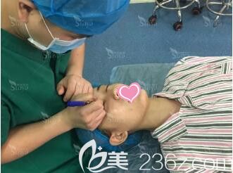 割雙眼皮術前劃線設計局麻