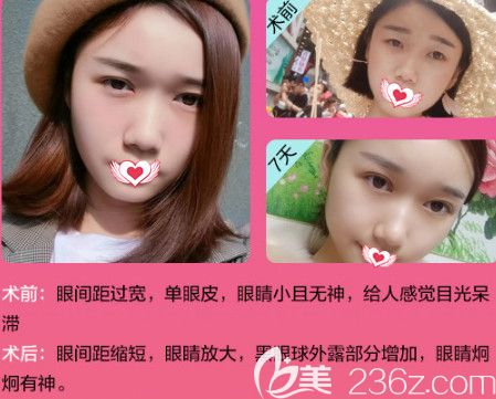 五月整形保定哪家醫(yī)院有優(yōu)惠?華美整形美容醫(yī)院全場3折雙眼皮手術降到580元