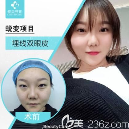 新疆黎美雙眼皮怎么樣