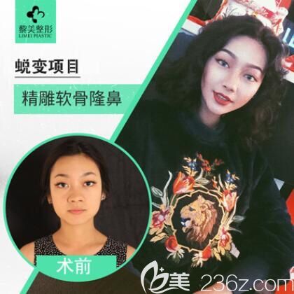 新疆黎美鼻綜合案例