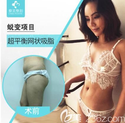 新疆黎美吸脂效果好不好