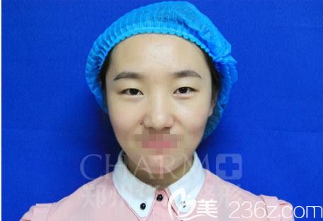 鄭州醫(yī)德佳員工親身體驗阿爾法美眼術(shù)2.0