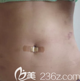 全身吸脂后腰腹部的樣子