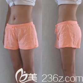 濰坊華美做全身吸脂手術(shù)挺好的，我做完腰腹、大腿和手臂恢復(fù)的也快