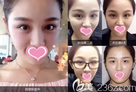 愛思特靈韻精雕大眼術(shù)真人前后效果對比照