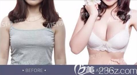 愛思特魔力溝豐胸真人前后效果對比圖片