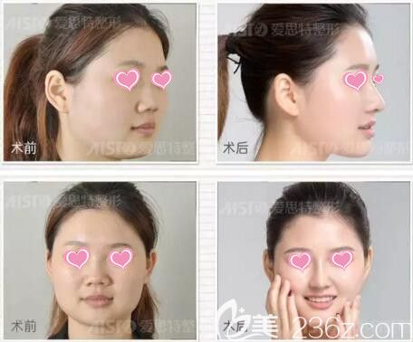 愛思特芭比三體真鼻術(shù)真人前后效果對比照片
