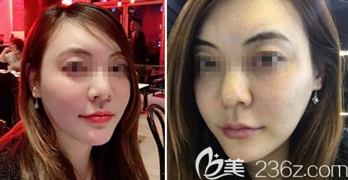 在韓國ARTLINE皮膚科做了埋線提升之后2個(gè)月就改善了我下垂的下頜緣