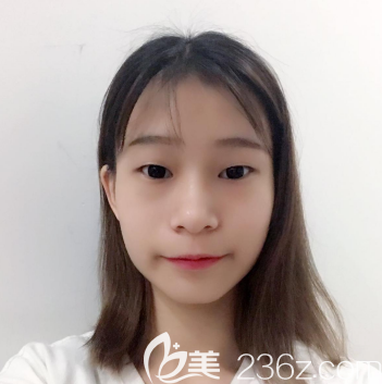 在汕頭曙光割雙眼皮術前照片 在汕頭曙光割雙眼皮術前照片