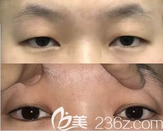 做眼綜合整形的術(shù)前照 做眼綜合整形的術(shù)前照