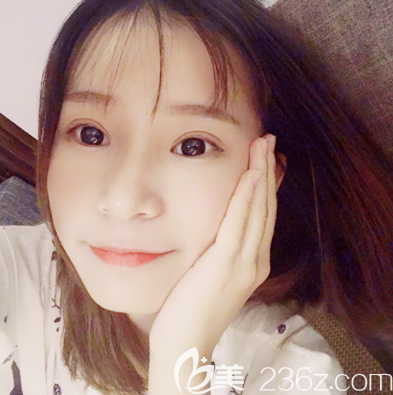 來看我在汕頭曙光做的雙眼皮怎么樣 來看我在汕頭曙光做的雙眼皮怎么樣