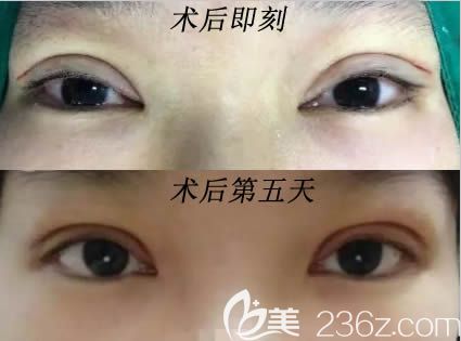 長春姬安娣做眼綜合術(shù)后即刻照和第五天照 長春姬安娣做眼綜合術(shù)后即刻照和第五天照