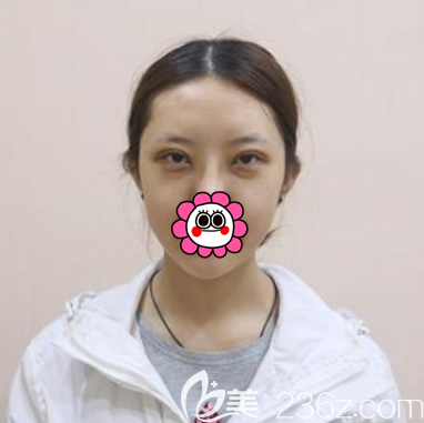 在北京壹加壹做眼綜合術(shù)后即刻樣子 在北京壹加壹做眼綜合術(shù)后即刻樣子