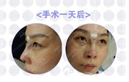 4月31日整形外科金載勛做鼻子怎么樣 4月31日整形外科金載勛做鼻子怎么樣