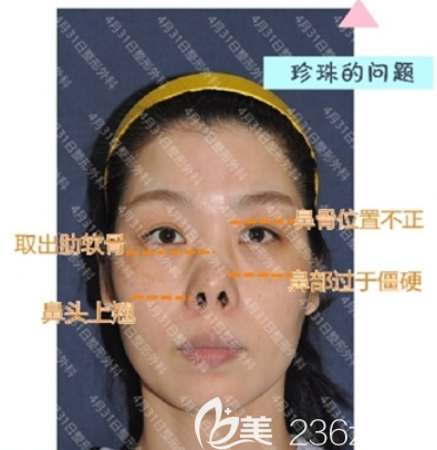 4月31日整形外科金載勛動態(tài)鼻尖手術(shù) 4月31日整形外科金載勛動態(tài)鼻尖手術(shù)