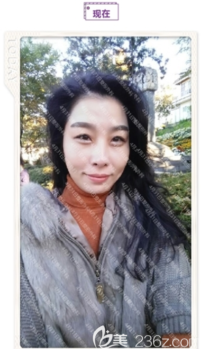 4月31隆鼻真人案例 4月31隆鼻真人案例