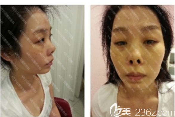 隆鼻失敗修復前 隆鼻失敗修復前