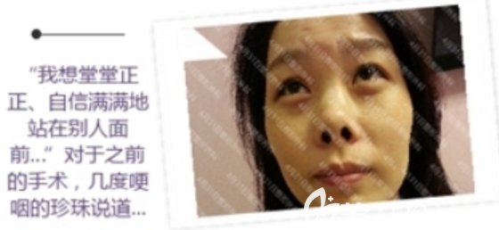 4月31日做鼻子怎么樣 4月31日做鼻子怎么樣