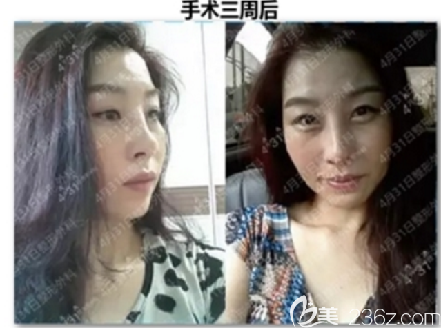 4月31日整形外科金載勛動態(tài)鼻尖手術(shù)拯救鼻整形失敗痛苦妹子！