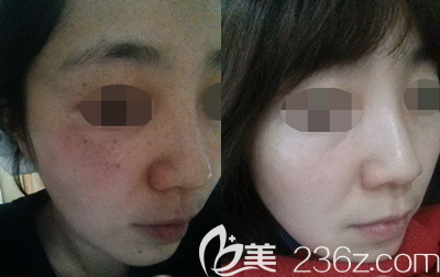 韓國(guó)美典皮膚科激光祛斑案例