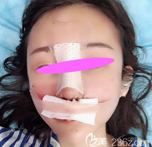 去上饒尚美整形醫(yī)院讓張維華主任做膨體+耳軟骨隆鼻術(shù)后第2天效果 去上饒尚美整形醫(yī)院讓張維華主任做膨體+耳軟骨隆鼻術(shù)后第2天效果