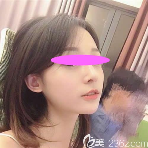 去上饒尚美整形醫(yī)院讓張維華主任做膨體+耳軟骨隆鼻術(shù)后一個(gè)半月效果 去上饒尚美整形醫(yī)院讓張維華主任做膨體+耳軟骨隆鼻術(shù)后一個(gè)半月效果