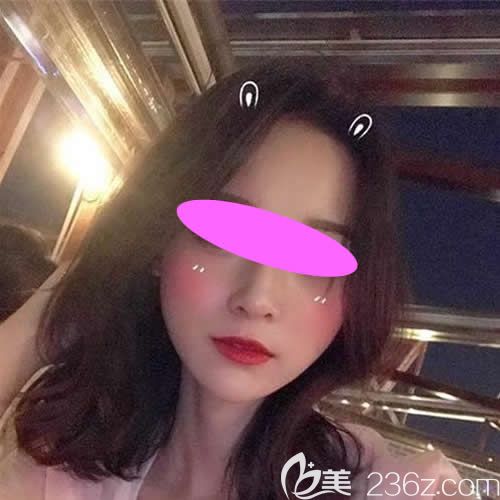 花8600塊找上饒尚美整形張維華做膨體+耳軟骨隆鼻三個(gè)月后，朋友都說這錢沒白花