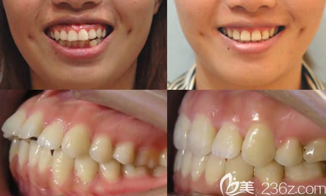 泉州維樂口腔楊華牙齒正畸效果前后對比 泉州維樂口腔楊華牙齒正畸效果前后對比