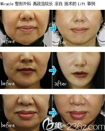 韓國美來可整形醫(yī)院禹政浩院長埋線面部提升案例術(shù)前與術(shù)后2年效果比較 韓國美來可整形醫(yī)院禹政浩院長埋線面部提升案例術(shù)前與術(shù)后2年效果比較