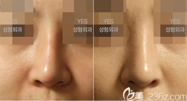 韓國(guó)yes整形外科醫(yī)院隆鼻案例 韓國(guó)yes整形外科醫(yī)院隆鼻案例