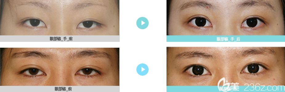 韓國YES整形外科雙眼皮案例 韓國YES整形外科雙眼皮案例