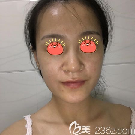 紹興藝美整形做硅膠隆鼻術(shù)前 紹興藝美整形做硅膠隆鼻術(shù)前